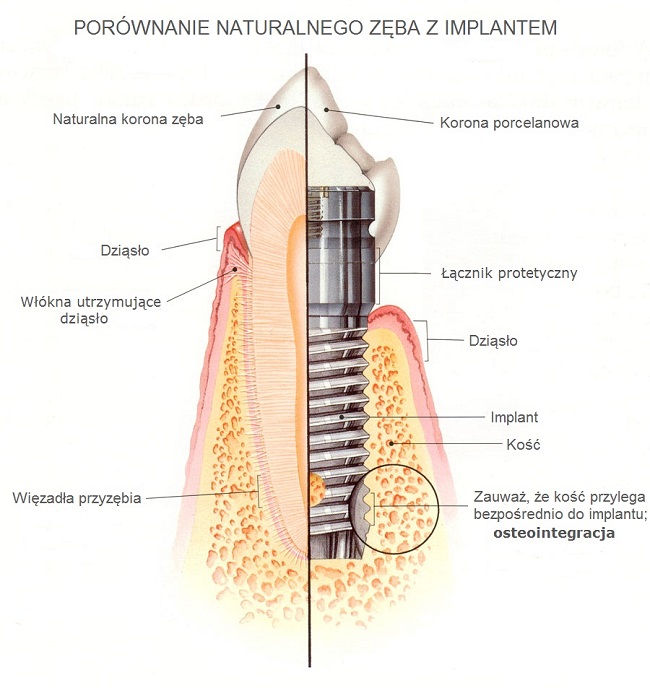 Porównanie naturalnego zęba z implantem